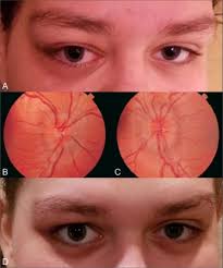 Hodgkin's lymphoma — formerly known as hodgkin's disease — is a cancer of the lymphatic system, which is part of your immune system. Hodgkin Lymphoma Presenting With Orbital Involvement Canadian Journal Of Ophthalmology