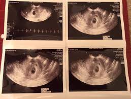 Ob Doctor Visits Page 2 Over 40 First Time Mom