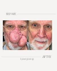 Extensive Rhinophyma Excision 1 year post op result. Surgeon: Timothy Doerr,  MD FACS Pre Op Diagnosis: Rhinophyma causing significant nasal obstruction.  Procedure: Rhinophyma excision with loop cautery, cold steel and CO2 laser.