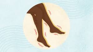 Image result for Restless Leg Syndrome