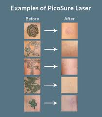 If your clients want to alter, cover, or even completely erease their old permanet makeup , there is an alternative to laser treatments now available. Uberskin Tattoo Removal Picosure