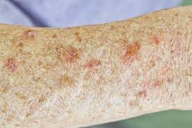 Treatment for an actinic keratosis may include: Actinic Keratosis Pictures Causes And Prevention