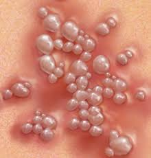 Image result for genital herpes