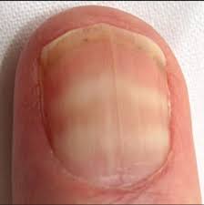 Image result for Muehrcke Line