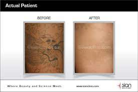 While mostly effective, laser tattoo removal isn't exactly a quick fix. Laser Tattoo Removal Procedure At Sian Skincare Clinic