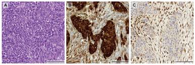 Mesothelioma is a cancer caused by the inhalation or epithelioid mesothelioma is the most common type of mesothelioma; Ijms Free Full Text Heterogeneity In Malignant Pleural Mesothelioma Html