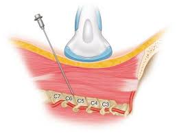 Image result for Lower Cervical Intramuscular Injection