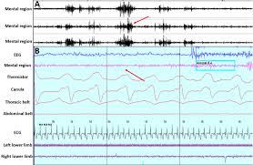 Image result for REM Sleep Behavior Disorder