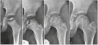 This affects the epiphysis of the femur, which is the bone distal to the growth plate (physis). Legg Calve Perthes Disease Core Em