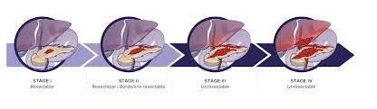 Primary liver cancer (cancer that starts in the liver) and secondary liver cancer (cancer that begins elsewhere and spreads to the liver) cause the same symptoms. The Stages Of Pancreatic Cancer Immunovia