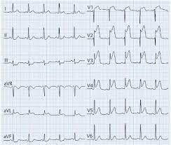 Zurzeit ist bei einem akuten infarkt. So Diagnostizierst Du Einen Herzinfarkt Klinik Via Medici