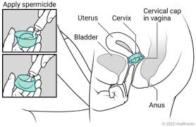 Image result for Cervical Cap