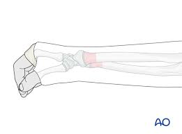 Image result for Long Arm Cast