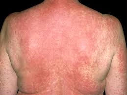 In urticaria, the skin gets raised in patches with itching. Drug Rash And Eruption Symptoms Pictures Causes And Treatment