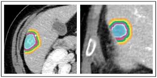 Radiomic Gradient in Peritumoural Tissue of Liver Metastases: A Biomarker  for Clinical Practice? Analysing Density, Entropy, and Uniformity  Variations with Distance from the Tumour