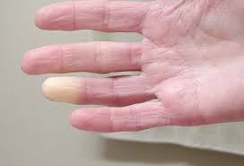 Image result for Chilblains