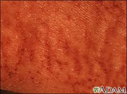 Xerosis cutis refers to abnormally dry skin. Xerosis Information Mount Sinai New York
