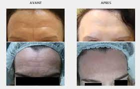 The disease is commonly called limberneck. Traitement Des Rides Toxine Botulique Dysport Estheticon Fr
