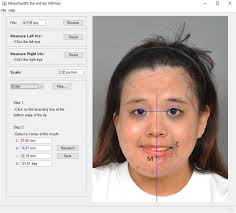 Deep-plane facelift technique for managing extensive hemifacial tumors: A  retrospective study