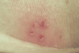 Image result for genital herpes