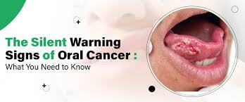 Image result for dental cancer