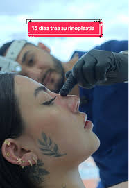 13 días tras su #rinoplastia y el cambio es evidente ¿Qué les parece?  #rinoplastia #rino #rinoplasty #rinomodelacion