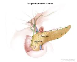 It causes the belly to swell and stretch out. Pancreatic Cancer Hematology Oncology Associates Of Cny
