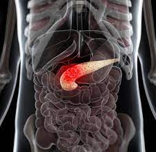 Bauchspeicheldruse Diese Diagnose Ist Ihr Todesurteil Fast Immer Welt