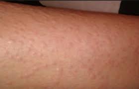 The secret to removing ingrown hairs on legs forever no one likes the sight or feeling of an inflamed red welt. Ingrown Hairs After Waxing