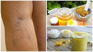 Como Preparar Uma Pomada De Arnica Para Atenuar As Varizes E Microvarizes Melhor Com Saude