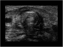 Check spelling or type a new query. Head And Neck 4 1 Thyroid Gland Case 4 1 1 Thyroid Congenital Abnormalities Ultrasound Cases
