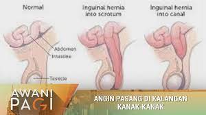 Seperti kebanyakan orang, anda mungkin mengaitkan masalah hernia dengan aktiviti angkat berat. Awani Pagi Angin Pasang Di Kalangan Kanak Kanak Youtube