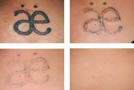 Salabration At Home Tattoo Removal Before And After Pictures At Home Tattoo Removal Tattoo Removal Cost Faded Tattoo