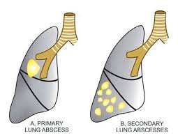 Image result for Lung Abscess