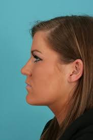 Rhinoplasty Case Examples
