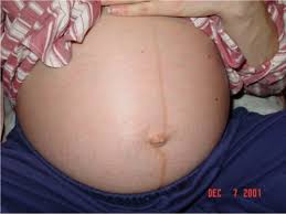 When does the linea nigra go away? Derm In Pregnancy Flashcards Quizlet