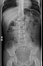 Image result for Fecal Incontinence