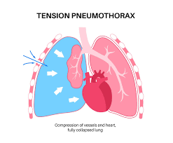 Image result for Open Pneumothorax