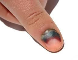 Sometimes melanoma under the nail has black streaks, or even digs in just like an ingrown toenail. Subungual Hematoma Symptoms Causes And Treatment