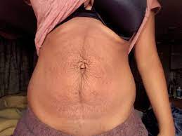 Post Baby Tummy March 2017 Babies Forums What To Expect