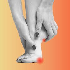 They manifest on your ankles and soles of your feet. Types Of Warts And How To Treat Them A Visual Guide Allure