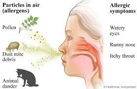 Allergic Rhinitis Flashcards Quizlet