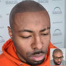 Scalp micropigmentation before and after photos. Who Benefits From Micropigmentation Got Scalp