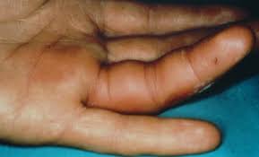 Image result for phlegmon of hand)