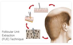 FUE Hair Transplant - The best method for hair restoration - Read More