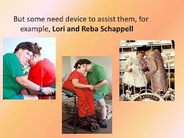 Like lori and reba schappell, these types of twins often share parts of the brain and cannot be separated. Conjoined Twins What Are Conjoined Twins Conjoined Twins Are The Partial Separation Of The Identical Twins Ppt Download