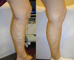 When is varicose vein removal deemed a cosmetic treatment? Pin On Back Neck Pain