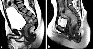 Transformation Of The Female Genitalia In Congenital Adrenal Hyperplasia Mri Study Journal Of Pediatric Surgery