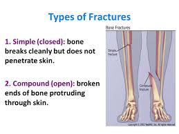 Bone Fractures Ppt Video Online Download