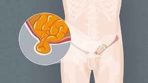 This may include pain or discomfort especially with coughing, exercise, or bowel movements. Die Haufigsten Hernien Und Ihre Ursachen Ksb Bauchzentrum